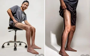 The Journey of Vietnam's Most Famous Limb-Lengthening Patient Today - image 4