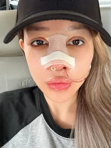 Ngan 98 Sparks Discussion After Revealing High Cost of Nose Surgery - image 1
