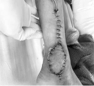 Medical Breakthrough: Successful Ankle Joint Reconstruction for 8-Year-Old Cancer Patient - image 6