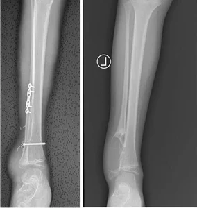 Medical Breakthrough: Successful Ankle Joint Reconstruction for 8-Year-Old Cancer Patient - image 5