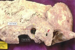 Mysterious Marks on Ancient Greek Skull Reveal Shocking Truth - image 2