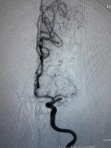 Rare Medical Case: Understanding Double Stroke in Senior Patients - image 0