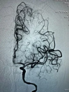 Rare Medical Case: Understanding Double Stroke in Senior Patients - image 1