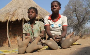 The Mystery of the Ostrich People: Understanding the Vadoma Tribe's Unique Genetic Condition - image 5