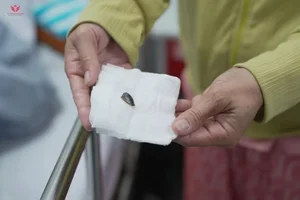 Medical Miracle: Sapodilla Seed Successfully Removed from Elderly Woman's Lung After Two Months - image 2