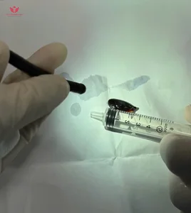 Medical Miracle: Sapodilla Seed Successfully Removed from Elderly Woman's Lung After Two Months - image 1