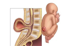 Medical Milestone: Successful Surgery for Rare Meningocele Case in Vietnam - image 1