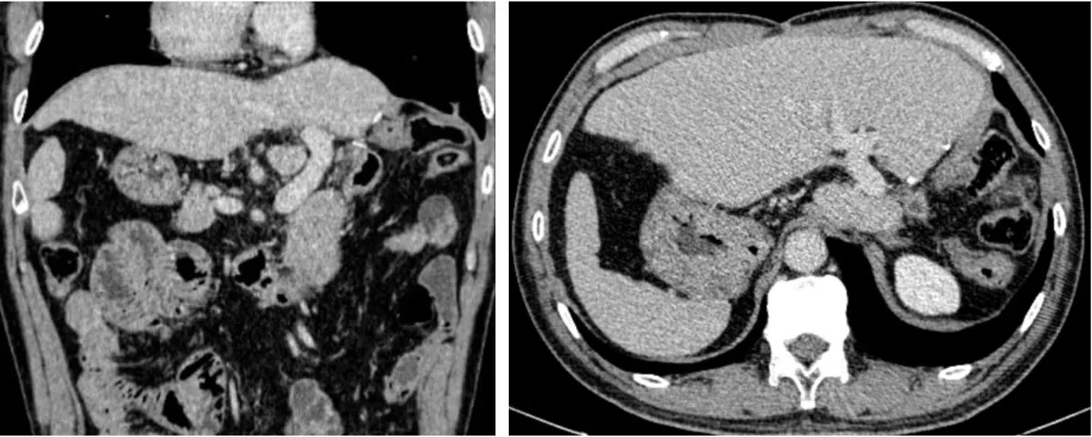 Modern Medical Breakthroughs: Treating Late-Stage Liver Cancer with New Technology