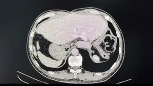 Modern Medical Breakthroughs: Treating Late-Stage Liver Cancer with New Technology - image 3