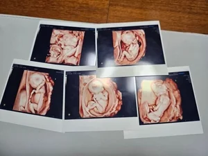 Rare Medical Miracle: 24-Year-Old Woman Delivers Natural Quintuplets with 20 Doctors Present - image 3