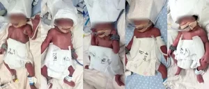 Rare Medical Miracle: 24-Year-Old Woman Delivers Natural Quintuplets with 20 Doctors Present - image 1