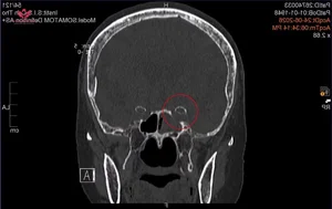 Medical Milestone: Successful Skull Base Surgery Treats Invasive Sphenoid Sinus Mycosis - image 1