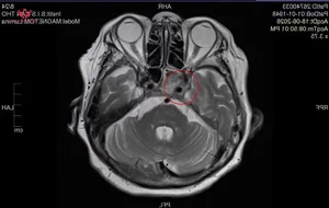 Medical Milestone: Successful Skull Base Surgery Treats Invasive Sphenoid Sinus Mycosis - image 2